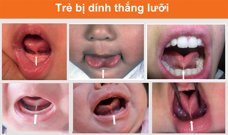 Nguyên nhân và ảnh hưởng của dính thắng lưỡi